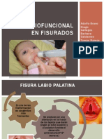 Terapia Miofuncional en Fisurados