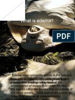 EDEMA