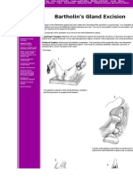 Bartholin's Gland Excision