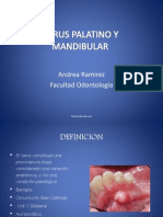 Torus Palatino y Mandibular