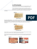 Classifications of Occlusion