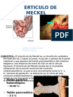 Diverticulo de Meckel