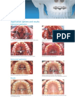 Palatal Distractor