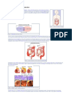 Ulcerative Colitis