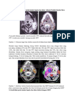 Terapi Radiasi Lanjutan Untuk Kanker Kepala Dan Leher
