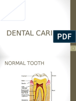 Dental Caries