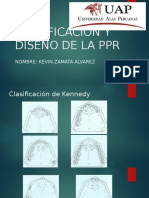 Diseño de La Prótesis Parcial Removible