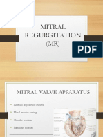 Mitral Regurgitation