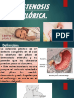 Estenosis Pilórica