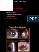 Acquired 2. Isolated Familial Ectopia Lentis 3. Associated With Systemic Syndromes