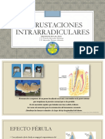 INCRUSTACIONES INTRARRADICULARES (Autoguardado)