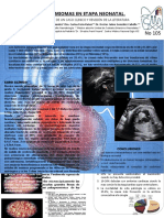 Rabdomiomas en Etapa Neonatal.