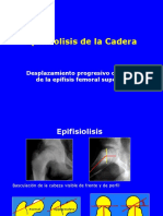  Epifisiolisis de Cadera