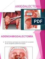 ADENOAMIGDALECTOMIA