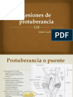 Lesiones de Protuberancia