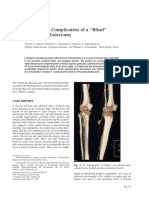 An Unusual Complication of A Blind'' Femoral Embolectomy: Case Report