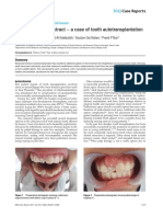 Think Before You Extract - A Case of Tooth Autotransplantation