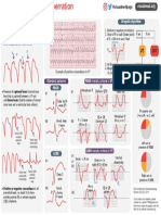 Interpretation Cheat Sheet: VT SVT