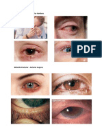 Blefaritis Posterior - Anterior