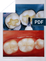 The Dual Bonding Technique