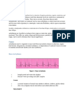 Arrhythmia: Causes