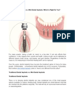 Dental Implants vs. Mini Dental Implants: Which Is Right For You?