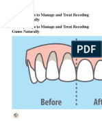 10 Easy Ways To Manage and Treat Receding Gums Naturally