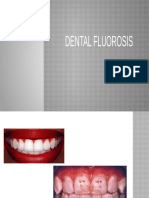 Dental Fluorosis