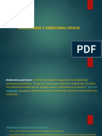 Atelectasia y Hemitorax Opaco - En.es