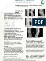 Tratamiento de Genu Valgo Unilateral para Imprimir