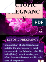 Ectopic Pregnanc Y Ectopic Pregnanc Y