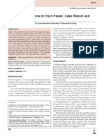 Squamous Papilloma On Hard Palate: Case Report and Literature Review