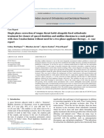 Single Phase Correction of Tongue Thrust Habit Alo