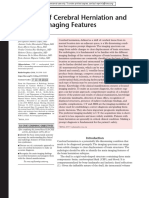 Types of Cerebral Herniation and RX