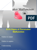 Pacemaker Malfunction