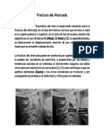 Fractura Del Ahorcado