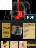 Esophageal Diverticula