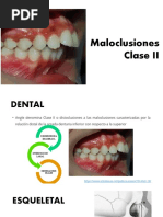 Maloclusiones Clase II