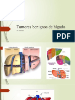 Tumores Benignos de Hígado