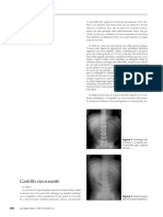 Gastritis Necrosante: M. J. Pérez Rodríguez, F.M. Anaya Barea, A. Rosa García e I. Condado Sánchez-Rojas