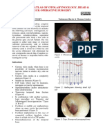 Subtotal Petrosectomy