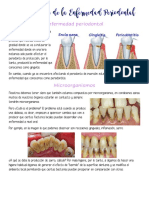 Enfermedad Periodontal