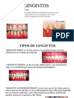 Gingivitis: ¿Que Es La Gingivitis?