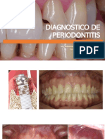 Clasificacion de Periodontitis Upla