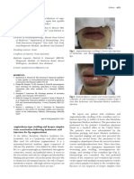 Lip Angioedema Swellimng and HSV Following HA Inj