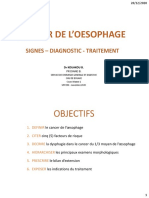 Cancer de L'oesophage