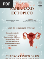 Embarazo Ectopico