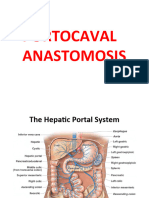 Portocaval Anastomosis