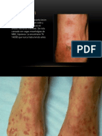 VASCULITIS