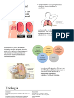 Derrame Pleural